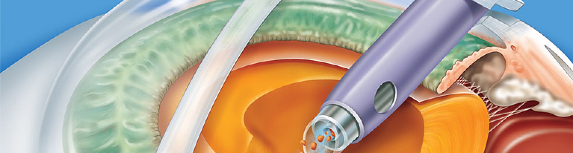 Cirurgia de Catarata