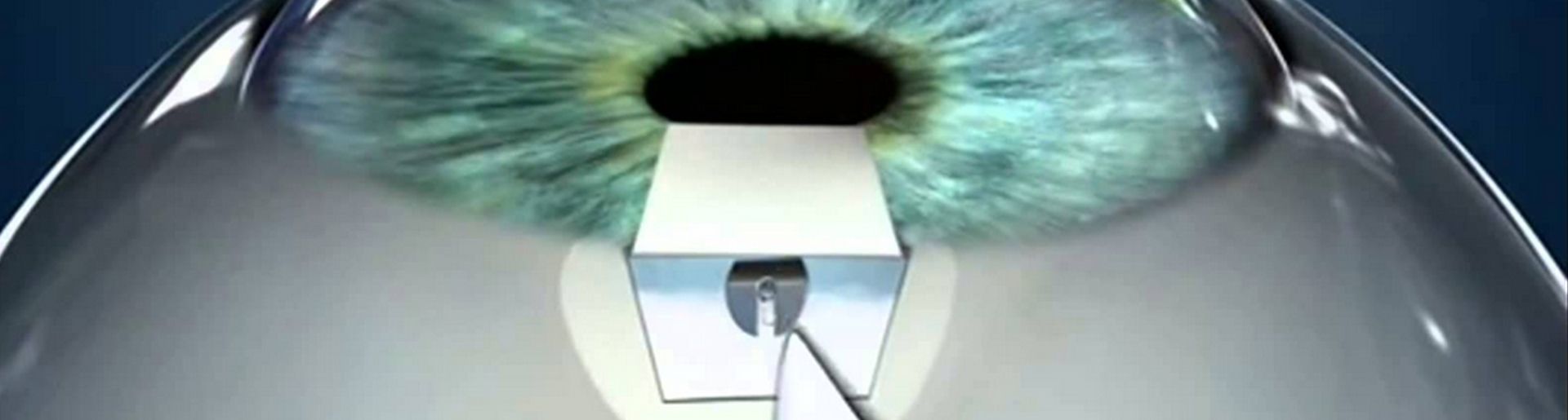 Cirurgia de Glaucoma