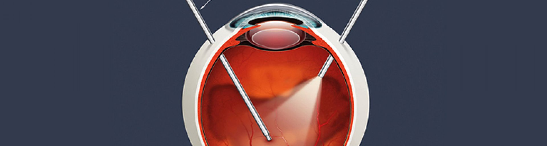 Cirurgia de Retina e Vítreo
