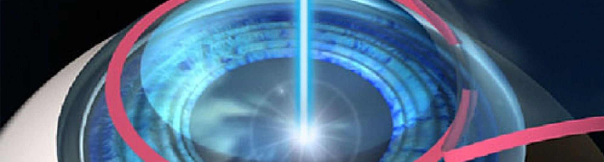 Cirurgia Refrativa a Laser