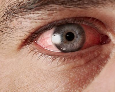 Síndrome do olho seco em adolescentes